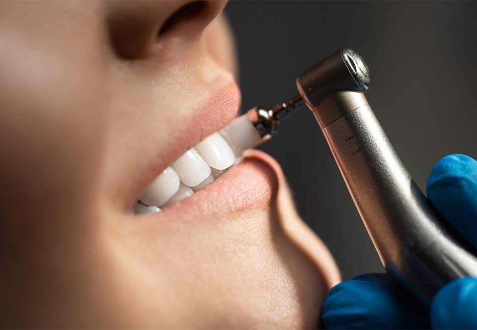 Professional Teeth Cleaning