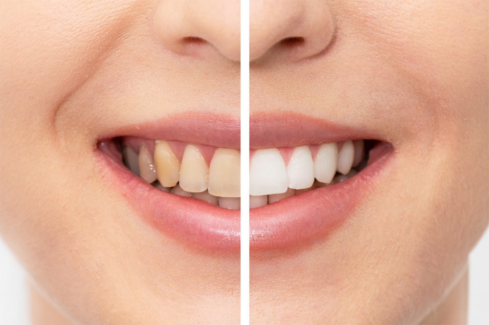 Teeth Whitening