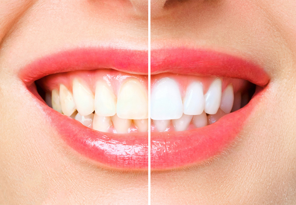 Teeth Whitening